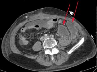 Imaging Studies image of Intraabdominal abscess