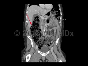 Imaging Studies image of Large bowel obstruction - imageId=8359789. Click to open in gallery.  caption: '<span>Coronal image from a CT scan demonstrating dilated ascending colon with large amount of stool. The remainder of the large bowel loops were also dilated, consistent with a large bowel obstruction.</span>'