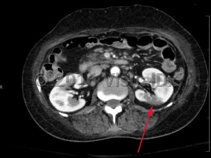 Imaging Studies image of Renal infarction - imageId=8361316. Click to open in gallery.  caption: '<span>Axial image from enhanced CT scan of the abdomen showing a wedge-shaped peripheral region of low attenuation in the posterior aspect of the mid left kidney.</span>'