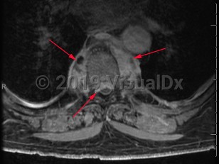Imaging Studies image of Paraspinal abscess