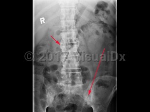 Imaging Studies image of Ankylosing spondylitis - imageId=8367603. Click to open in gallery.  caption: 'X-ray of abdomen showing erosion and reactive sclerosis invoving bilateral sacroiliac joints (long arrow), as well as bony spurs (syndesmophytes), along lateral aspects of lumbar vertebral bodies (short arrow). These are hallmark findings of ankylosing spondylitis.'