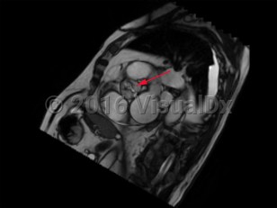 Imaging Studies image of Aortic stenosis - imageId=8368063. Click to open in gallery.  caption: '<span>Cardiac MRI without contrast demonstrates aortic stenosis.</span>'