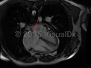 Imaging Studies image of Atrial septal defect
