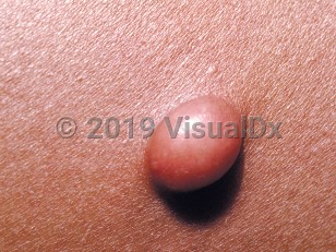 Clinical image of Solitary neurofibroma - imageId=84289. Click to open in gallery.  caption: 'A close-up of a smooth pinkish nodule.'