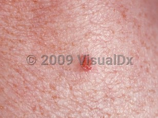 Clinical image of Clear cell acanthoma - imageId=84671. Click to open in gallery.  caption: 'A close-up of a bright red, flat-topped, scaly papule.'