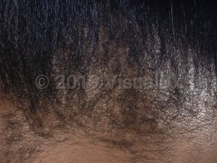 Clinical image of Traction alopecia - imageId=848460. Click to open in gallery.  caption: 'Patchy nonscarring alopecia at the anterior hairline.'