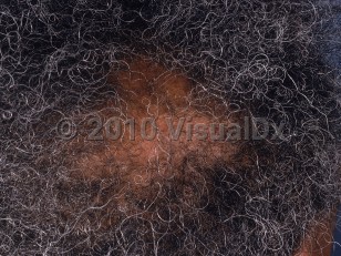 Clinical image of Central centrifugal cicatricial alopecia
