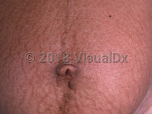 Clinical image of Striae - imageId=848847. Click to open in gallery.  caption: 'Multiple brown, curvilinear and linear, atrophic plaques with a rippled appearance on the abdomen of a pregnant patient.'