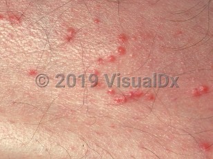 Clinical image of Fire ant sting