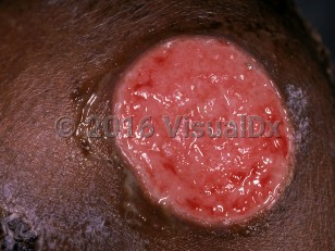 Clinical image of Tertiary syphilis - imageId=860159. Click to open in gallery.  caption: 'A close-up of a round ulcerated plaque.'