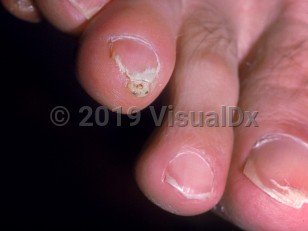 Clinical image of Dracunculosis - imageId=867933. Click to open in gallery.  caption: 'A white papule with a central tiny punctum on the distal toe.'