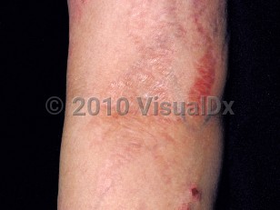 Clinical image of Steroid atrophy