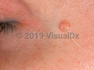 Clinical image of Trichofolliculoma - imageId=874496. Click to open in gallery.  caption: 'A pink papule with a central light gray hair egressing from it on the temple.'