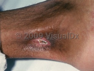 Clinical image of Sickle cell disease