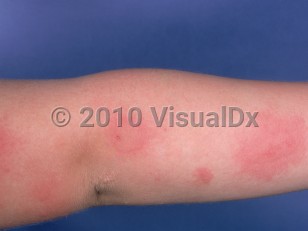 Clinical image of Solar urticaria - imageId=879551. Click to open in gallery.  caption: 'Urticarial plaques on the extensor forearm.'