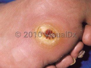 Clinical image of Neurogenic ulcer - imageId=88325. Click to open in gallery.  caption: 'An ulcerated hyperkeratotic plaque on the distal sole.'