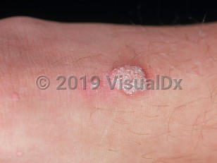 Clinical image of Common wart