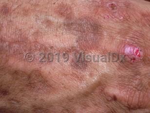 Clinical image of Variegate porphyria - imageId=887807. Click to open in gallery.  caption: 'A close-up of a pink scar with a superficial overlying crust and some surrounding atrophic hyperpigmented scars, on the dorsal hand.'