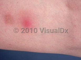 Clinical image of Nodular vasculitis - imageId=888633. Click to open in gallery.  caption: 'A close-up of a pink nodule with surrounding pink erythema on the leg.'