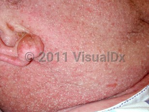Clinical image of Acute generalized exanthematous pustulosis
