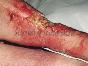 Clinical image of Progressive bacterial synergistic gangrene - imageId=89164. Click to open in gallery.  caption: 'Full thickness loss extending into the deep subcutaneous tissue.'