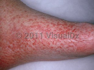 Clinical image of Leukocytoclastic vasculitis