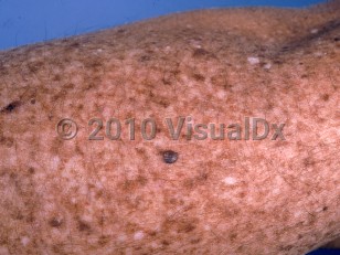 Clinical image of Xeroderma pigmentosum - imageId=895843. Click to open in gallery.  caption: 'Diffuse hypo- and hyperpigmentation and a variegated brown and gray papule (melanoma) on the arm.'