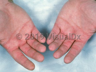 Clinical image of Palmar xanthomas - imageId=899007. Click to open in gallery.  caption: 'Pink and yellowish papules and plaques in and around the palmar and finger creases.'