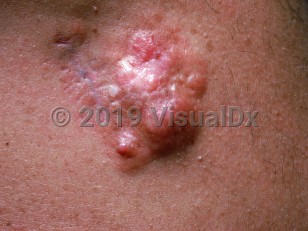 Clinical image of Dermatofibrosarcoma protuberans - imageId=905284. Click to open in gallery.  caption: 'A close-up of a bosselated, white, pink, and brown plaque and an adjacent surgical scar.'