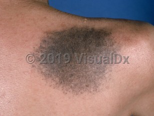 Clinical image of Nevus of Ito - imageId=915383. Click to open in gallery.  caption: 'A large brown-gray patch on the upper back.'
