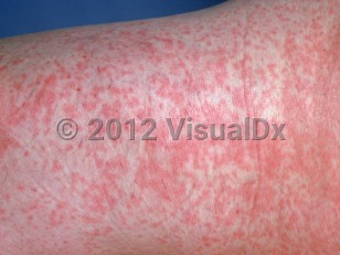 Clinical image of Rubella - imageId=915460. Click to open in gallery.  caption: 'A close-up of pink macules, papules, and patches on the thigh.'