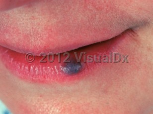 Clinical image of Venous lake - imageId=916544. Click to open in gallery.  caption: 'A deep bluish-purple papule on the lower lip.'