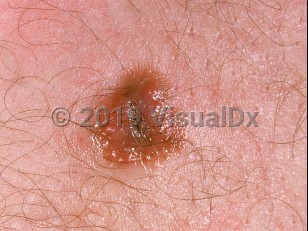 Clinical image of Spitz nevus - imageId=919616. Click to open in gallery.  caption: 'A close-up of a crusted, pink and light brown papule.'