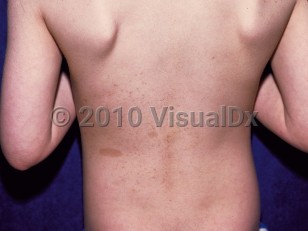 Clinical image of Mosaic neurofibromatosis 1 - imageId=92354. Click to open in gallery.  caption: 'Numerous light brown macules and patches (cafe au lait macules) in a cluster on the left lower back.'
