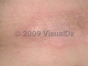 Clinical image of Morphea - imageId=92937. Click to open in gallery.  caption: 'A close-up of a shiny and wrinkled, white and yellowish plaque with a pink rim.'
