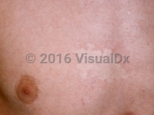 Clinical image of Nevus anemicus