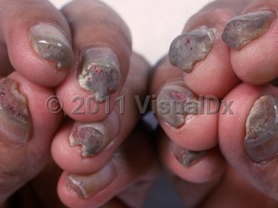 Clinical image of Pachyonychia congenita - imageId=934176. Click to open in gallery.  caption: 'Thickened, discolored fingernails with increased transverse curvature and subungual hyperkeratosis.'