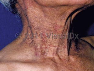 Clinical image of Pigmented contact dermatitis - imageId=93789. Click to open in gallery.  caption: 'Hyperpigmented and reddish patches on the neck.'