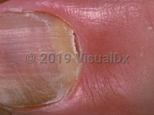 Clinical image of Onychomadesis - imageId=939124. Click to open in gallery.  caption: 'Proximal separation of the nail plate near the proximal nailfold.'