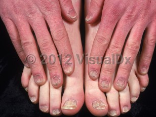 Clinical image of Trachyonychia - imageId=941645. Click to open in gallery.  caption: 'Thickened, roughened, dystrophic fingernails and toenails.'
