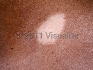 Clinical image of Postinflammatory hypopigmentation - imageId=95540. Click to open in gallery.  caption: 'A close-up of an oval white patch.'