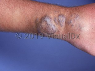 Clinical image of Cavernous hemangioma - imageId=956480. Click to open in gallery.  caption: 'Violaceous and skin-colored papules, nodules, and tumors on the forearm.'