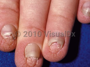 Clinical image of Hidrotic ectodermal dysplasia - imageId=96732. Click to open in gallery.  caption: 'Micronychia and a rugose appearance of the distal fingers.'