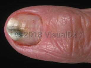 Clinical image of Pseudomonas nail infection - imageId=967363. Click to open in gallery.  caption: 'Deep greenish-black discoloration of an onycholytic nail (represented by the adjacent yellowish nail discoloration).'