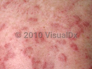 Clinical image of Jessner benign lymphocytic infiltrate - imageId=97167. Click to open in gallery.  caption: 'A close-up of numerous deeply erythematous papules and small arcuate plaques.'