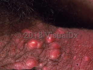 Clinical image of Scrotal calcinosis - imageId=976761. Click to open in gallery.  caption: 'Pink and orange papules on the scrotum.'