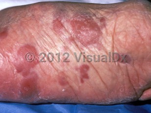 Clinical image of Cutaneous B-cell lymphoma - imageId=97692. Click to open in gallery.  caption: 'Smooth reddish-brown papules and plaques on the sole.'