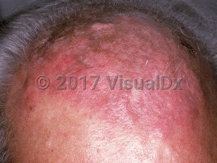 Clinical image of Angiosarcoma of skin - imageId=977208. Click to open in gallery.  caption: 'An extensive reddish and brownish plaque on the scalp and forehead.'
