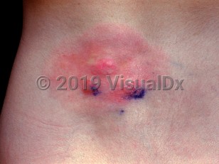 Clinical image of Fibrosarcoma - imageId=984128. Click to open in gallery. 