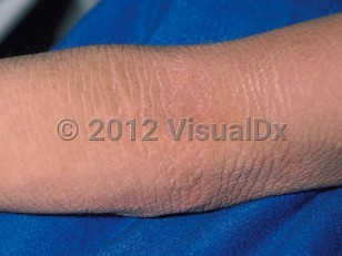 Clinical image of Bullous congenital ichthyosiform erythroderma - imageId=98460. Click to open in gallery.  caption: 'Ridged hyperkeratotic plaques and a background erythema on the arm.'